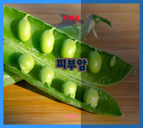 피부암